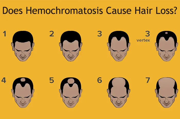 Does Hemochromatosis Cause Hair Loss? Exploring the Connection