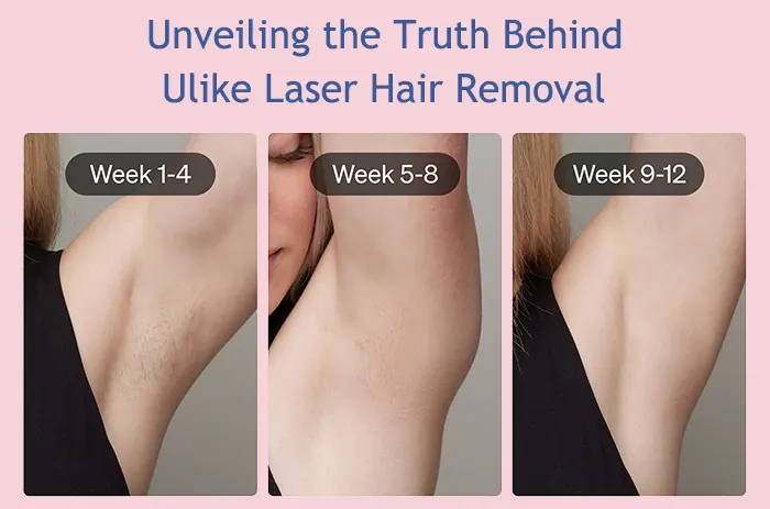 Unveiling the Truth Behind Ulike Laser Hair Removal